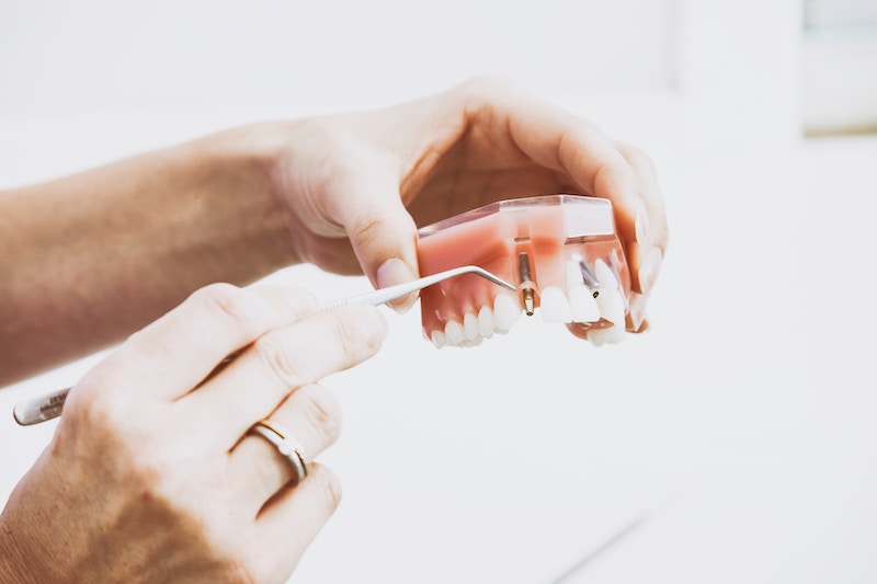dental-implants-towson-md