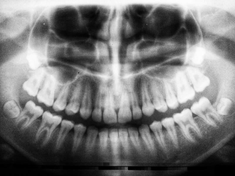 Dental-x-ray